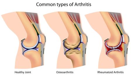 Common types of arthritis in the knee
